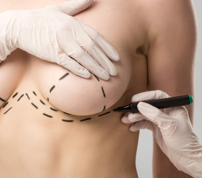 Breast Surgery