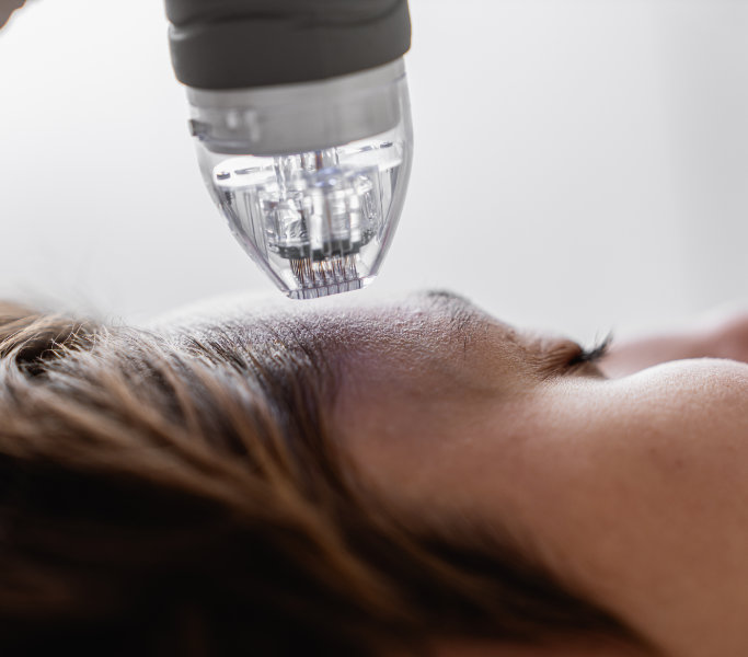 RF Microneedling