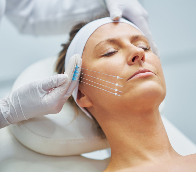 Facial Thread Lift